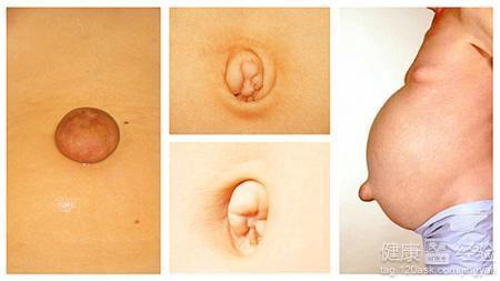 成人脐疝能跑步吗视频,成人脐疝患者跑步安全性的探讨  第1张