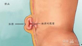 成人脐疝能跑步吗视频,成人脐疝患者跑步安全性的探讨  第2张